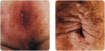 hemorrhoid_itch01_img01.jpg